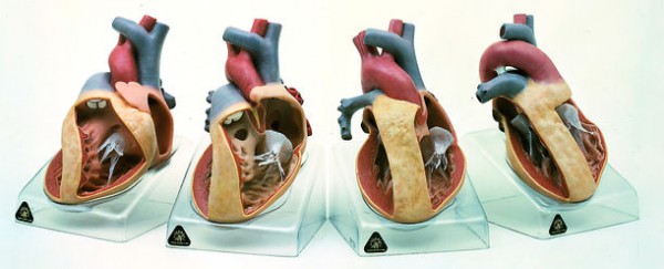 Modellserie mit der Darstellung angeborener Herzfehler