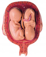 Uterus mit Zwillingsfeten im 5. Monat Uterus mit Zwillingsfeten im 5. Monat